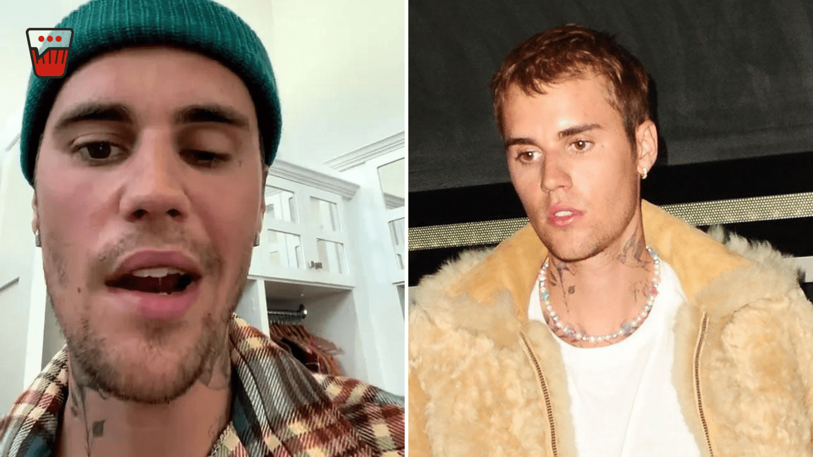 All You Need To Know About Justin Bieber's Diagnose Ramsay Hunt